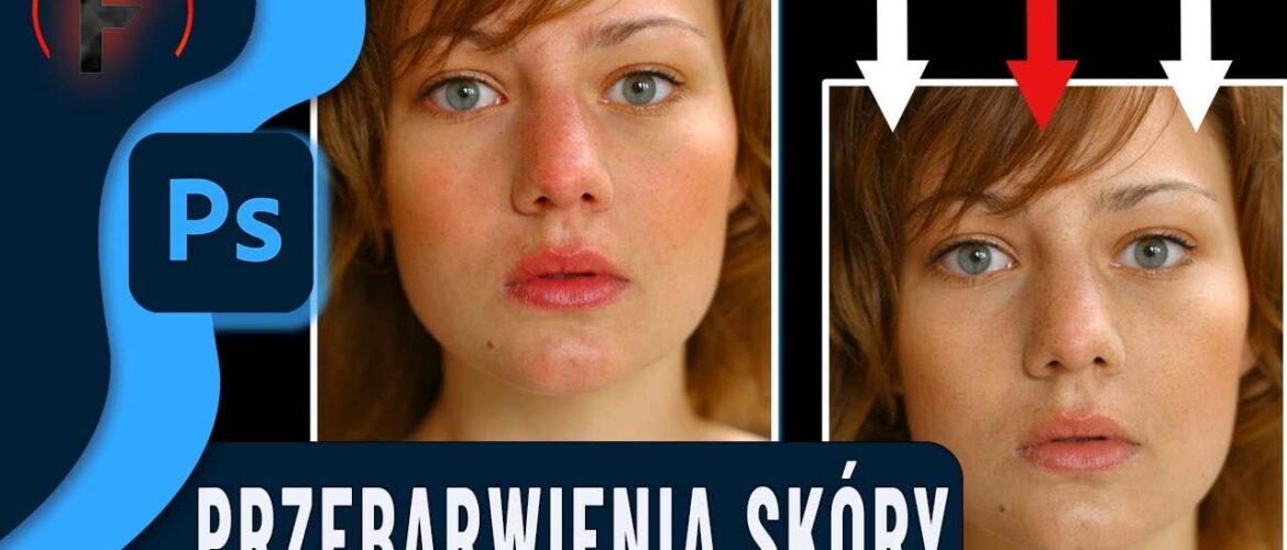 redukcja przebarwień skóry